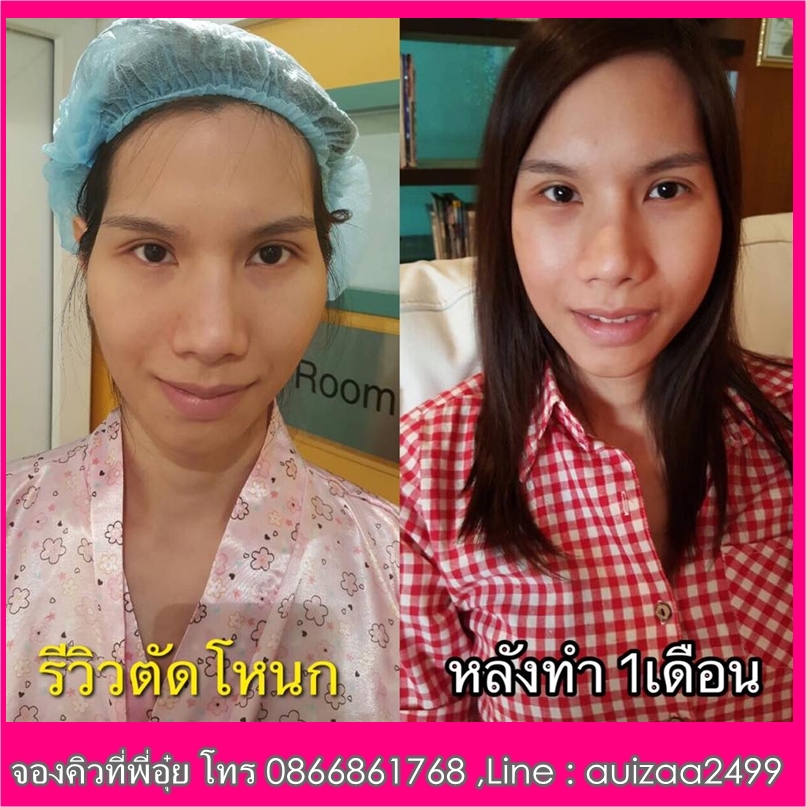 ทุบโหนกตัดกรามอาจารย์หมอปัญญา รูปที่ 4