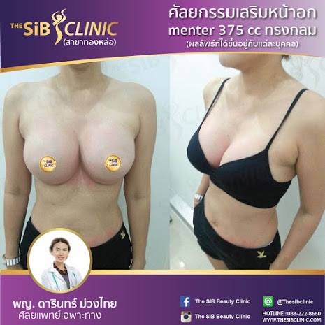 หมอดารินทร์เสริมหน้าอก ซิลิโคนอเมริกา092-4414623 รูปที่ 1