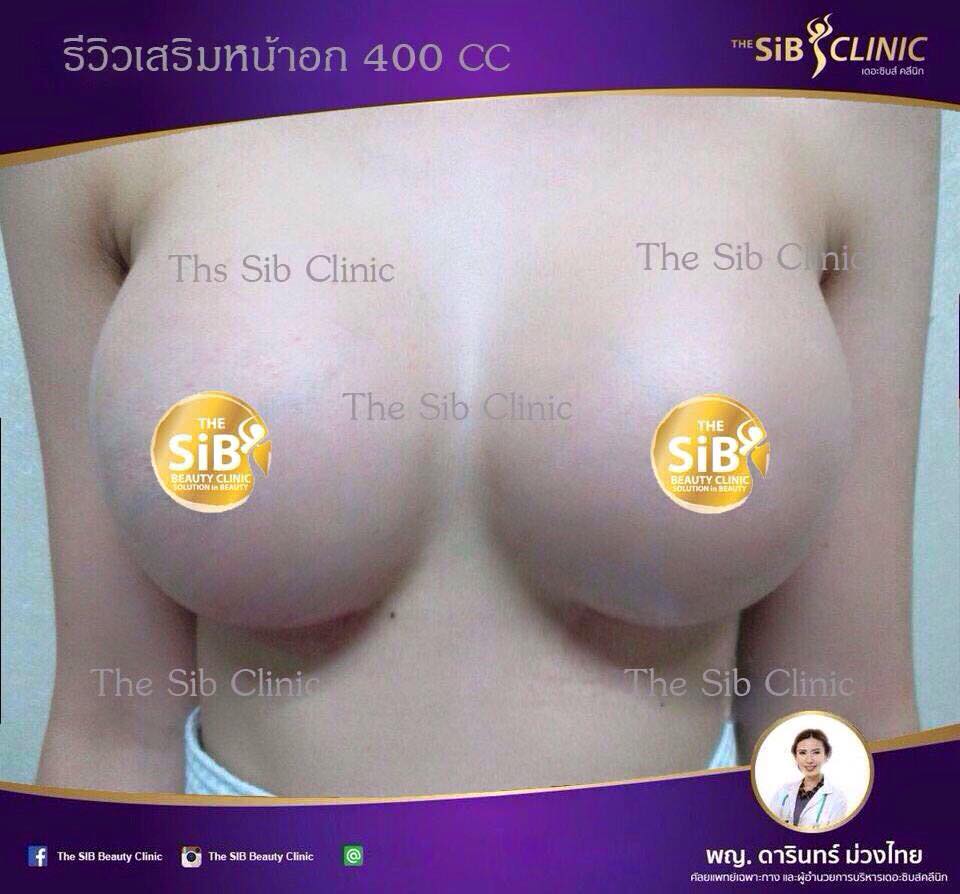 เสริมหน้าอกผ่านกล้องกับหมอดารินทร์ เ๗็บน้อย ฟื้นตัวเร็ว สอบถาม 092-4414623 รูปที่ 1