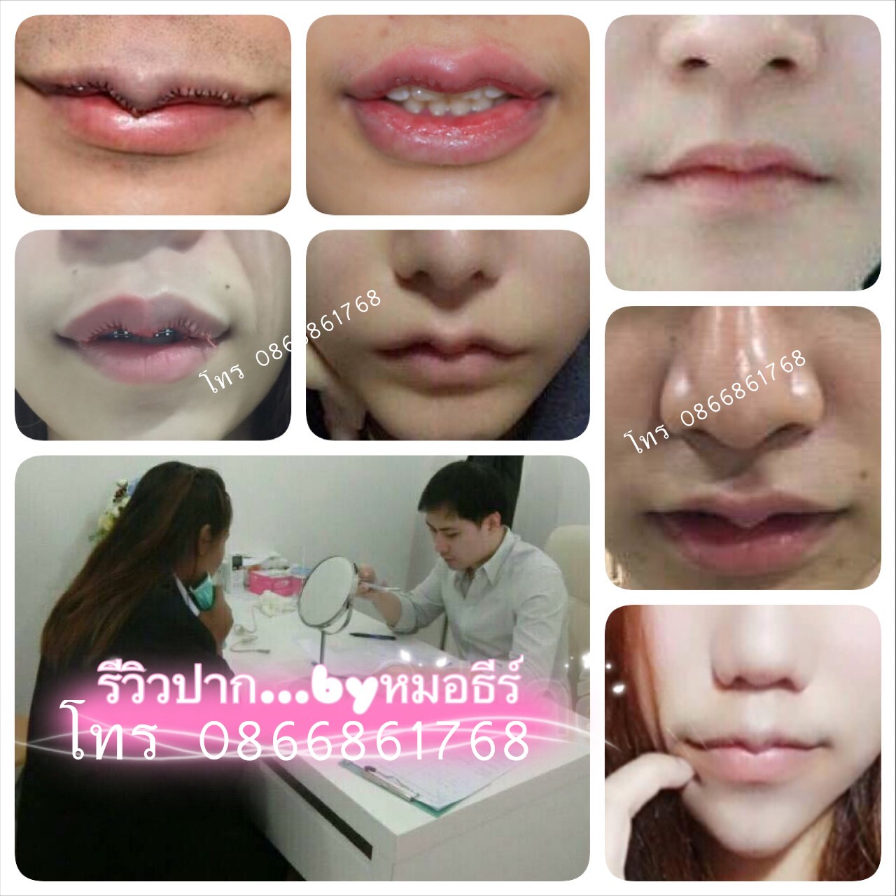 ตัดปากกระจับที่ไหนดี? ทำปากกระจับที่ไหนดี ? ทำปากกระจับ ทำปากบาง เริ่มตนไงดี นี้เลยพี่อุ๋ยมีหมอมาแนะนำ สวยสั่งได้ ศัลยกรรมปาก ศัลยกรรมตกแต่งริมฝีปากโดยหมอธีร์   ปรึกษาพี่อุ๋ย โทร. 0866861768 , ไลน์ @auizaa2499 หมอมีประสบการณ์มากกว่าพันเคส  เลิศดี ขอสวยแบบ ราคาคุ้มๆ ก็หมอธีร์นี้ละค่ะ อีกหนึ่งทางเลือกที่อยากแนะนำ รูปที่ 2