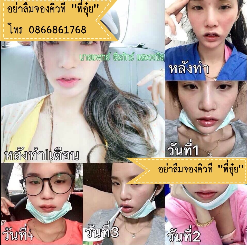 ตัดปากกระจับที่ไหนดี? ทำปากกระจับที่ไหนดี ? ทำปากกระจับ ทำปากบาง เริ่มตนไงดี นี้เลยพี่อุ๋ยมีหมอมาแนะนำ สวยสั่งได้ ศัลยกรรมปาก ศัลยกรรมตกแต่งริมฝีปากโดยหมอธีร์   ปรึกษาพี่อุ๋ย โทร. 0866861768 , ไลน์ @auizaa2499 หมอมีประสบการณ์มากกว่าพันเคส  เลิศดี ขอสวยแบบ ราคาคุ้มๆ ก็หมอธีร์นี้ละค่ะ อีกหนึ่งทางเลือกที่อยากแนะนำ รูปที่ 3
