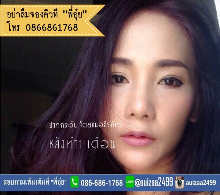 ตัดปากกระจับที่ไหนดี? ทำปากกระจับที่ไหนดี ? ทำปากกระจับ ทำปากบาง เริ่มตนไงดี นี้เลยพี่อุ๋ยมีหมอมาแนะนำ สวยสั่งได้ ศัลยกรรมปาก ศัลยกรรมตกแต่งริมฝีปากโดยหมอธีร์   ปรึกษาพี่อุ๋ย โทร. 0866861768 , ไลน์ @auizaa2499 หมอมีประสบการณ์มากกว่าพันเคส  เลิศดี ขอสวยแบบ ราคาคุ้มๆ ก็หมอธีร์นี้ละค่ะ อีกหนึ่งทางเลือกที่อยากแนะนำ รูปที่ 4
