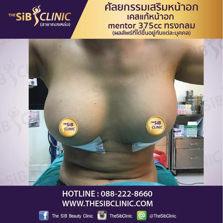 หมอดารินทร์เสริมหน้าอก แก้หน้าอก ไอดี fonjung63 รูปที่ 1