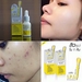 รูปย่อ I P L Kill Acne Serum เซรั่มฆ่ายันพ่อ ยันแม่สิว รูปที่4