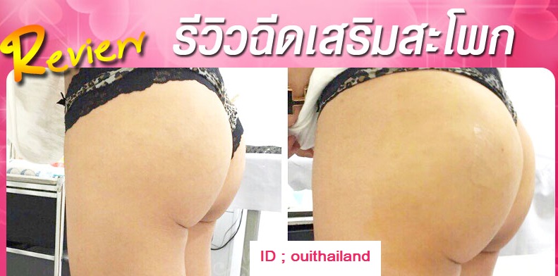 ฟิลเลอร์หน้าอก 100-500ซีๆ แบบไม่ต้องมีแผล พักฝื้น สวยโดยแพทย์ผู้เชียวชาญ  089-816-5225 รูปที่ 1