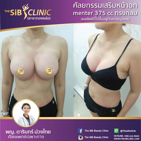 เสริมหน้าอกที่เดอะซิบคลินิก โดยแพทย์หญิงดารินทร์ ม่วงไทย รูปที่ 1