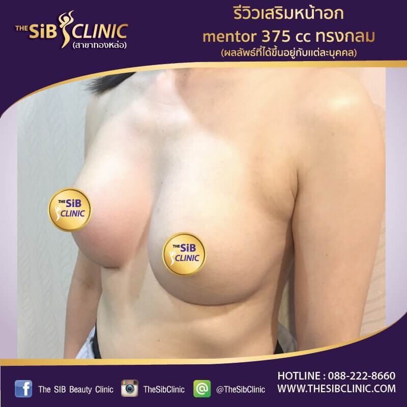 หมอดารินทร์ ศัลยแพทย์หญิง เสริมหน้าอก 092-4414623 รูปที่ 1