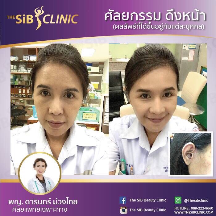 หมอดารินทร์ผ่าตัดดึงหน้า ผิวกระชับไม่หย่อนคล้อย โทร 0924414623 หรือไอดี fonjung63 รูปที่ 1