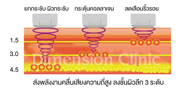 แรงข้ามปีโปรโมชั่นUltra HIFU ยกกระชับผิว1แถม1 สุดยอดกว่าHifuแบบเดิมเห็นผลทันทีคะ รูปที่ 4