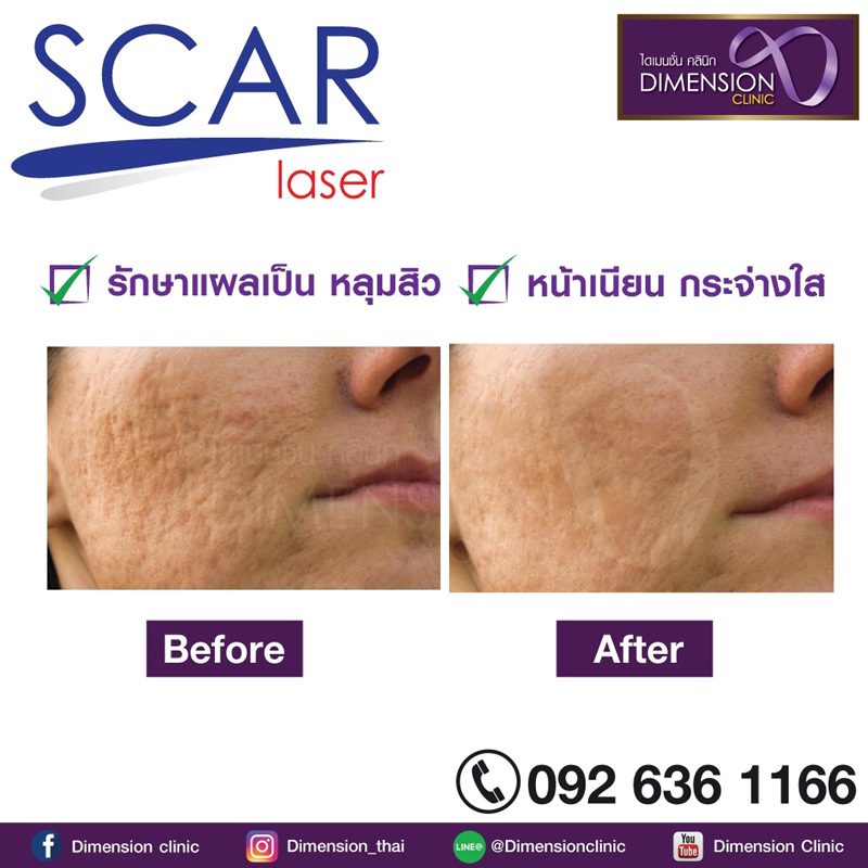 รักษาหลุมสิวคลินิก หน้าใสเด้งหลังรอยแผลเป็น หลุมสิว ผิวขรุขระ ผิวไม่เรียบหายไป รูปที่ 3