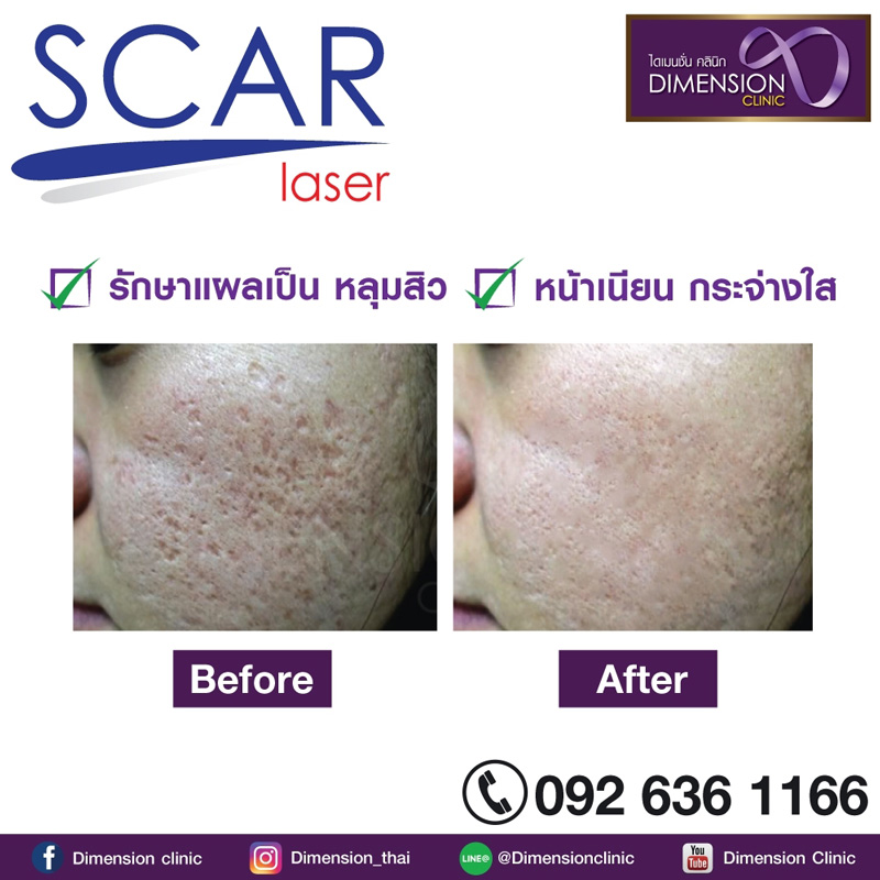 รักษาหลุมสิวคลินิก หน้าใสเด้งหลังรอยแผลเป็น หลุมสิว ผิวขรุขระ ผิวไม่เรียบหายไป รูปที่ 2