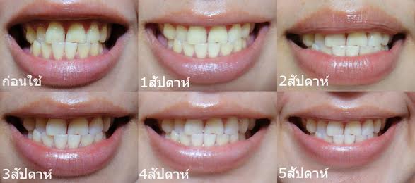 ยาสีฟันสมุนไพร อะโปโล  ตัวเดียวจบ ตอบโจทย์สุขภาพปากและฟัน รูปที่ 4