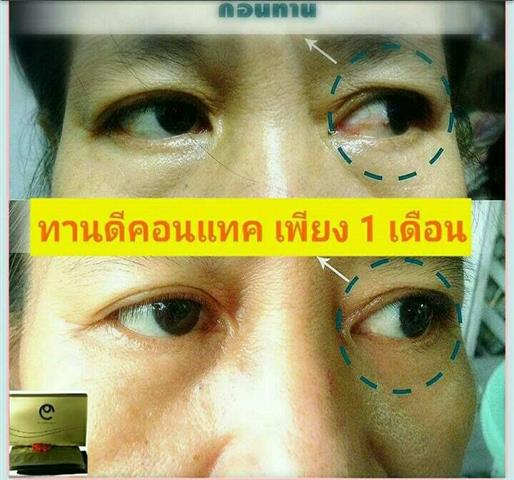 ดีคอนแทค D-contact อาหารเสริมเพื่อดวงตา ยอดขายอันดับ 1 ของเอเชีย  รูปที่ 7