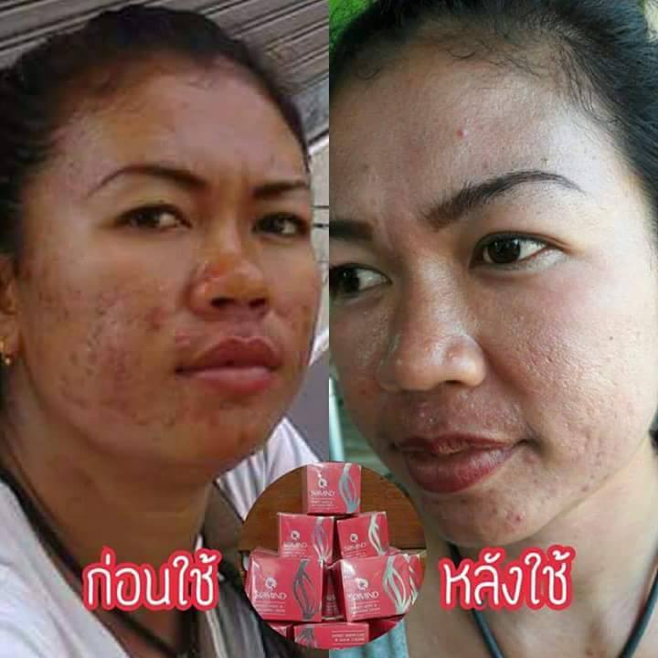 ครีมโซมายด์ Somind ครีมทาฝ้า ครีมหน้าใส ปลีก-ส่ง รับตัวแทนจำหน่าย รูปที่ 2