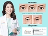 รูปย่อ ขยายหางตา ปรับมุมหางตา (โดย Lovely Eye and Skin Clinic by Dr.Roungkaw) รูปที่2