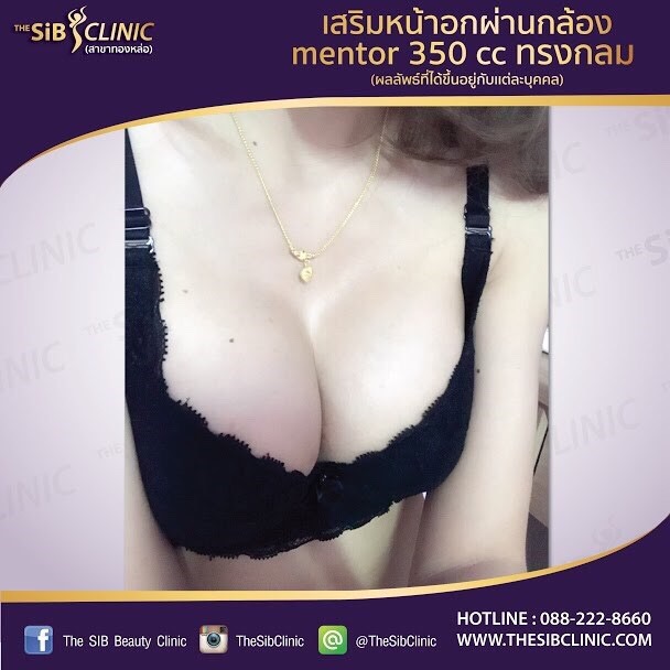 เสริมหน้าอกทรงบาร์บี้ ที่เดอะซิบคลินิกกับหมอดารินทร์. ไอดี fonjung63 รูปที่ 1