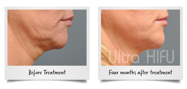 HIFU Face Lifting BUY1GET1 -60% thonglor55 Bangkok Dimension clinic รูปที่ 5