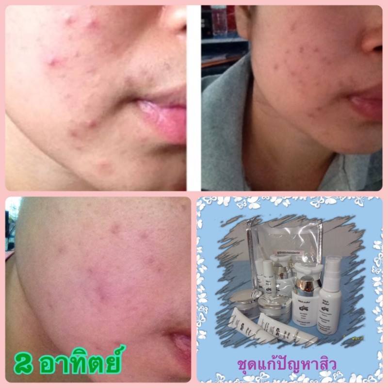 white perfect acne(the secret of beauty) รูปที่ 3