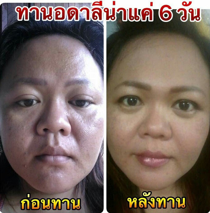 รอยตีนกา ถุงใต้ตา กระ ฝ้า สิว หายด้วย Adalina ชะลอความแก่ เห็นผลเร็ว ชัดเจน แน่นอนด้วย อดาลีน่า รูปที่ 2