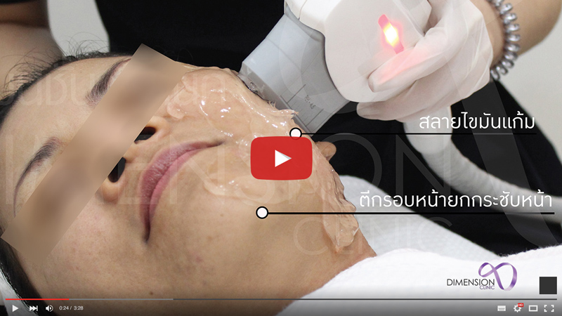 ยกกระชับหน้าเรียว เห็นผลในครั้งแรก ด้วย hifu ยกกระชับ ราคา1แถม1 แชร์กับเพื่อนได้ Dimension Clinic รูปที่ 3