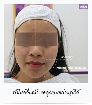 hifu ยกกระชับหน้า hifu คืออะไร hifu ที่ไหนดี hifu ราคาเท่าไหร่ เคลียทุกคำถามตอบกันยาวทำจริงสวยจริงขอแชร์ รูปที่ 5