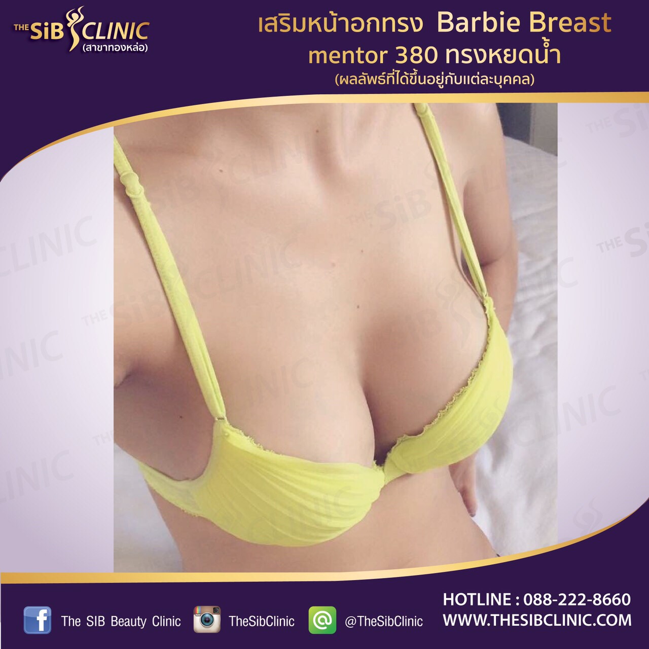 เสริมหน้าอกทรงบาร์บี้กับหมอดารินทร์ โทร 0924414623 รูปที่ 1