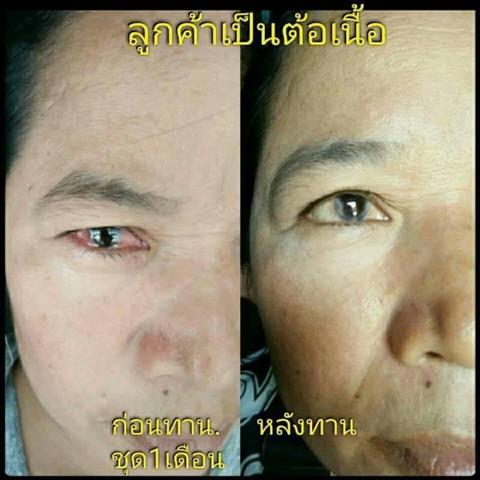 อาหารเสริมเพื่อดวงตา ดีคอนแทค D-contact  ยอดขายอันดับ 1 ของเอเชีย  รูปที่ 6