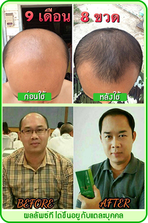 นีโอแฮร์ เซรั่มปลูกผม ขายดีอันดับ1  รูปที่ 5