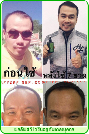 นีโอแฮร์ เซรั่มปลูกผม ขายดีอันดับ1  รูปที่ 7