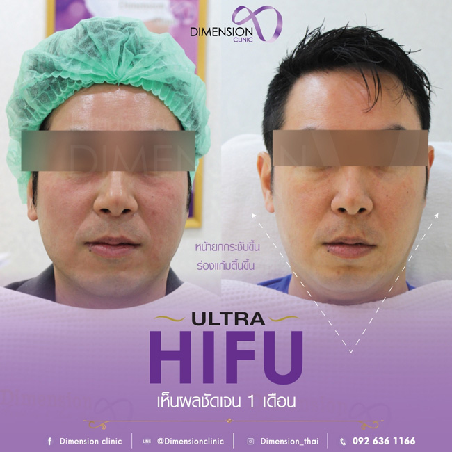 Promotion Hifu ยกกระชับหน้าเรียวเห็นผลชัดเจน ส่งท้ายปีที่ไดเมนชั่นคลินิก รูปที่ 3