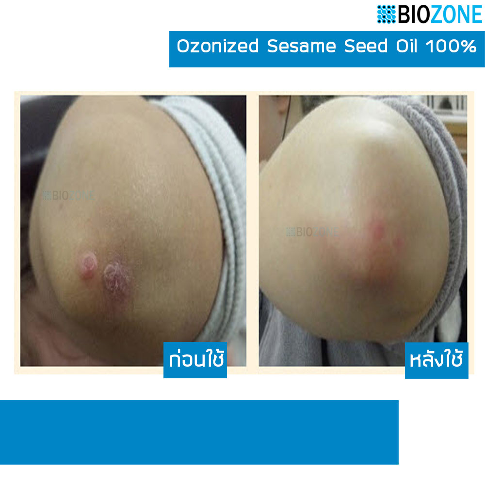 สร้างเซล์ลผิวใหม่x3เท่า สร้างคลอลาเจนตามธรรมชาติ หยุดแก่ ฆ่าเชื้อโรค Biozone Ozonized Sesame Seed Oil 100% รูปที่ 5