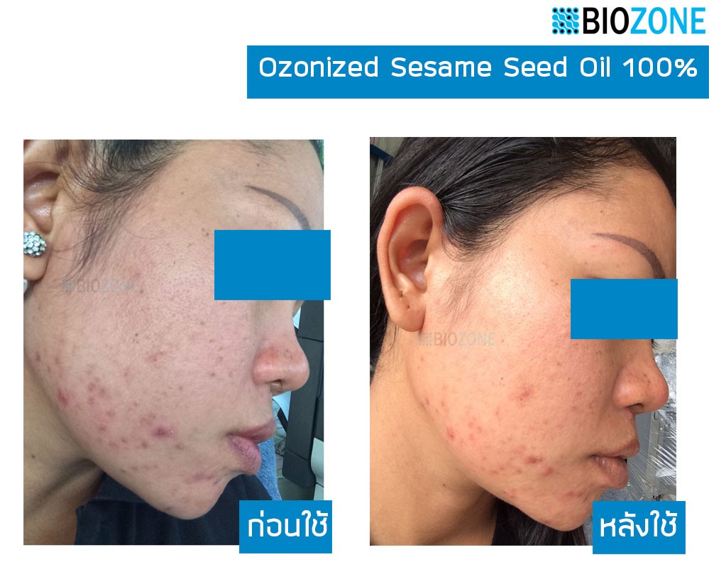 สร้างเซล์ลผิวใหม่x3เท่า สร้างคลอลาเจนตามธรรมชาติ หยุดแก่ ฆ่าเชื้อโรค Biozone Ozonized Sesame Seed Oil 100% รูปที่ 3