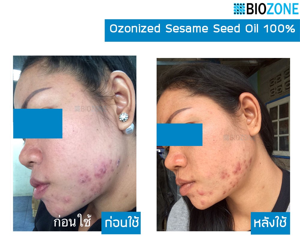 สร้างเซล์ลผิวใหม่x3เท่า สร้างคลอลาเจนตามธรรมชาติ หยุดแก่ ฆ่าเชื้อโรค Biozone Ozonized Sesame Seed Oil 100% รูปที่ 4