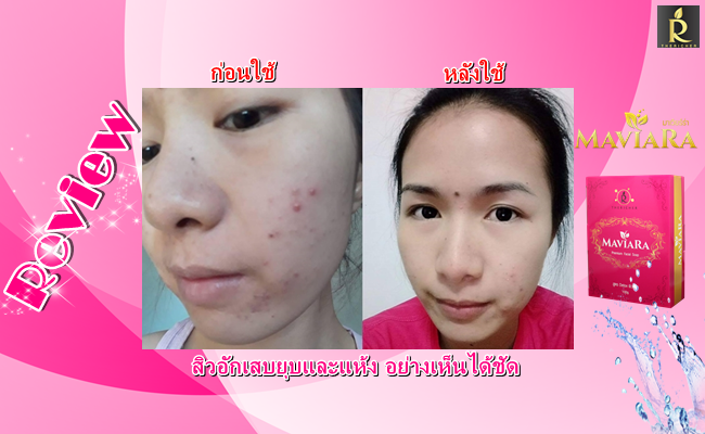 สบู่มาเวียร์ร่า รักษาสิว เห็นผลจริง มีรีวิวเพียบ!! รูปที่ 3