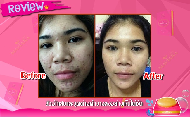 สบู่มาเวียร์ร่า ลดสิว ลดรอยดำ ลดริ้วรอย กระ ฝ้า รูปที่ 3