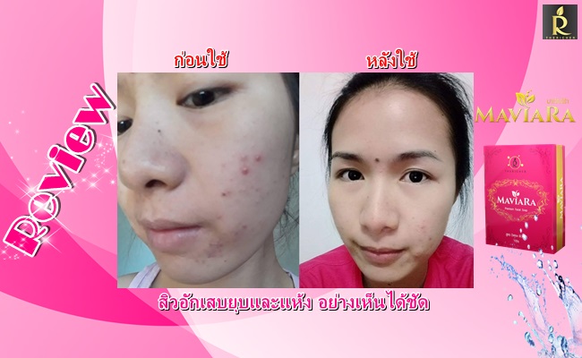 สบู่มาเวียร์ร่า ลดสิว ลดรอยดำ ลดริ้วรอย กระ ฝ้า รูปที่ 7
