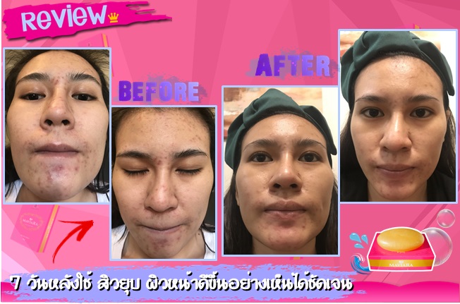 สบู่มาเวียร์ร่า ลดสิว ลดรอยดำ ลดริ้วรอย กระ ฝ้า รูปที่ 5