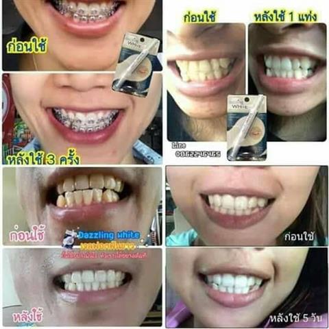 เปลี่ยนฟันเหลือง ให้ขาวใน 7 วัน ด้วย Dazzling white รูปที่ 6