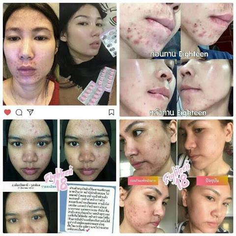 Garden me Blossom Gel การ์เด้นมี ผลิตภัณฑ์ดูแลผิวหน้าเพื่อผิวขาวใสย้อนวัย รูปที่ 5
