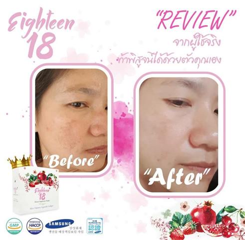 Eighteen เอธ-ธีน อาหารผิว 