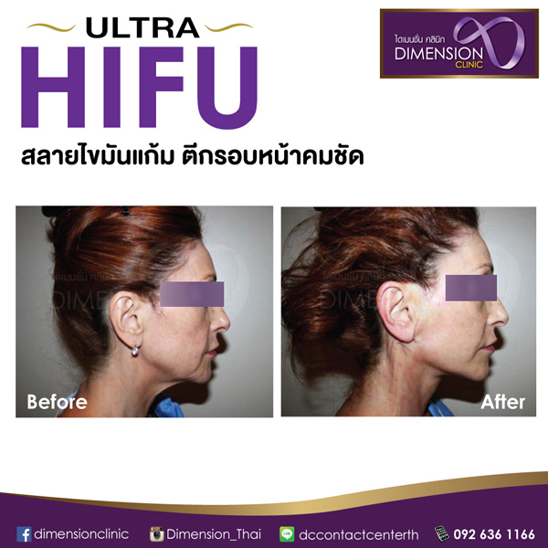 Ultra Hifu 1แถม1 ปรับรูปหน้าเรียวกระชับ ไม่จำกัดช็อตแชร์กับเพื่อนได้ที่ DMCทุกสา รูปที่ 4