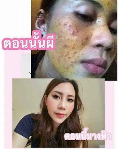 CL Collagen สวยครบจบในซองเดียว จบปัญหาสิว ฝ้า กระ จุดด่างดำ หลุมสิว รูปที่ 5