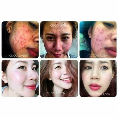 CL Collagen สวยครบจบในซองเดียว จบปัญหาสิว ฝ้า กระ จุดด่างดำ หลุมสิว รูปที่ 7