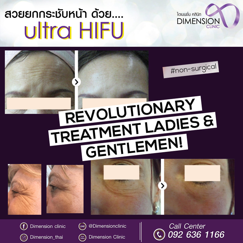 Ultra hifu อัลตร้า ไฮฟู 1แถม1 ตีกรอบหน้า สลายไขมัน หน้าวีเชฟสวย ไม่จำกัดshotsจ้า รูปที่ 4