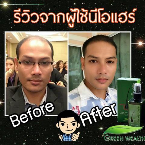 NEOHAIR LOTION ทุกปัญหาของเส้นผมจะหมดไป รูปที่ 5