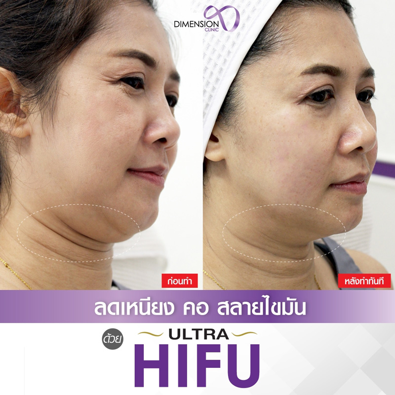 รีวิว Ultra Hifu 8900 1แถม1 ไม่จำกัดช็อตจริง ลดเหนียงลดคางยกหน้าได้เรียวจริงดิ รูปที่ 3
