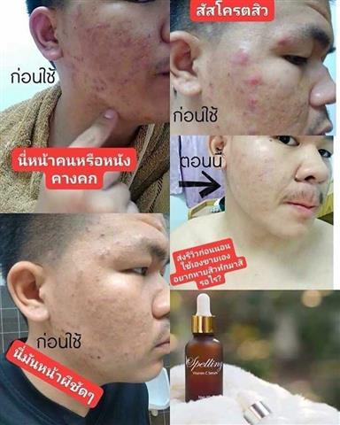 จำหน่าย Spelling ลดปัญหาสิว สิวแห้งไว ลบเลือนริ้วรอย  หน้ากระจ่างใสขึ้น รูปที่ 5