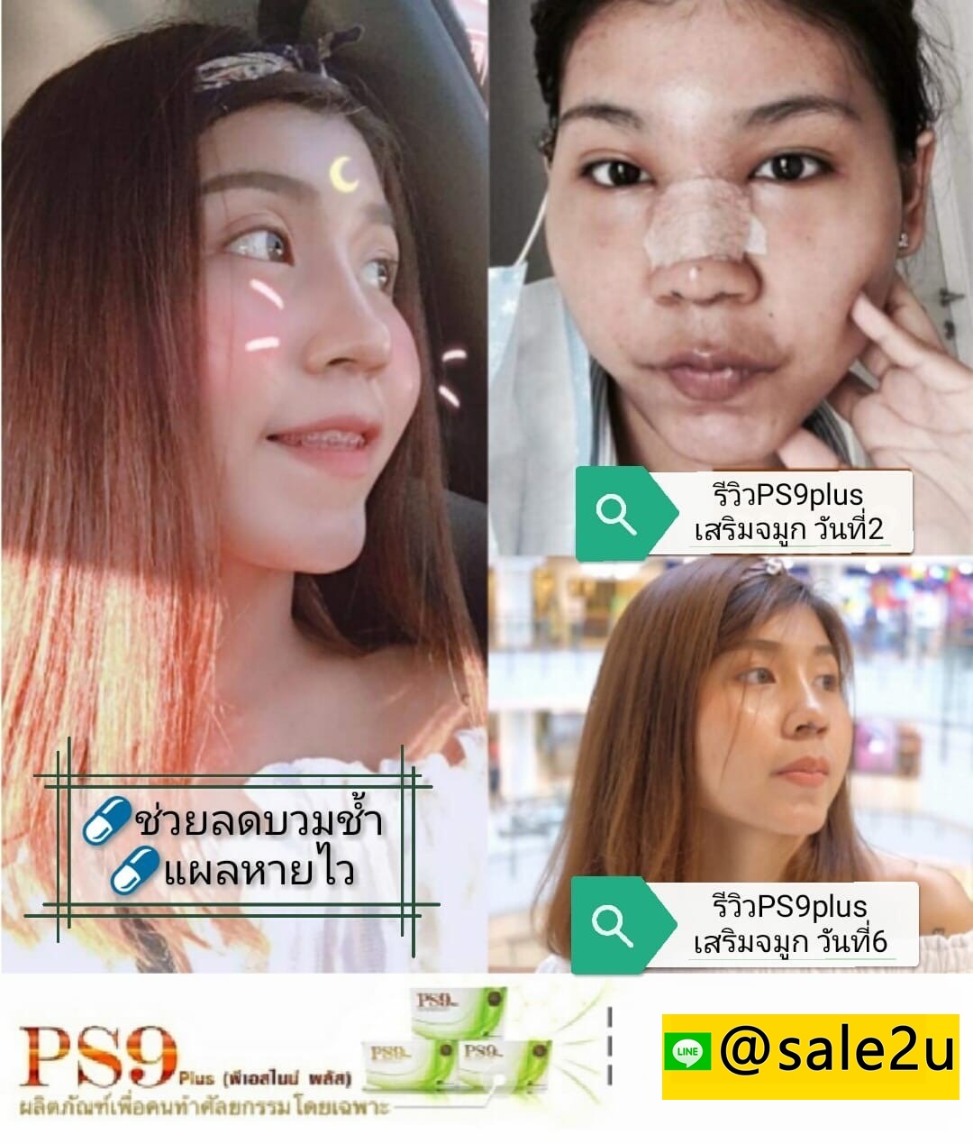 PS9 plus (พีเอสไนน์ พลัส) อาหารเสริมหลังศัลยกรรม รูปที่ 4