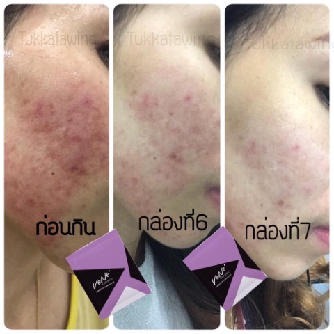 Vene VERLEN FIBER ดีท๊อกซ์ลำไส้ ขับถ่ายดี ชะลอการเกิดริ้วรอย ผิวเปล่งปลั่ง  ดูมีสุขภาพดี รูปที่ 4