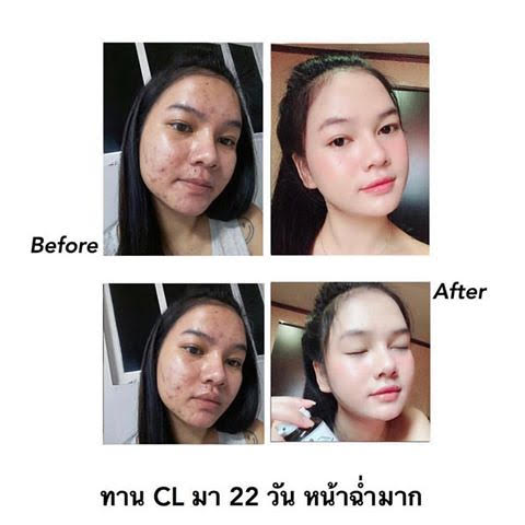 CL Collagen 12 ซีแอล คอลลาเจน ทั้งผิวใสและลดสิว  สวยครบจบในตัวเดียว รูปที่ 7